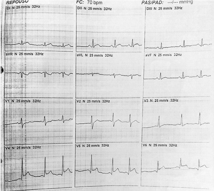 Joven de 19 años con antecedente de episodio febril y odinofagia hace una semana que presenta dolor toráccico y disnea con signos de miopericarditis aguda