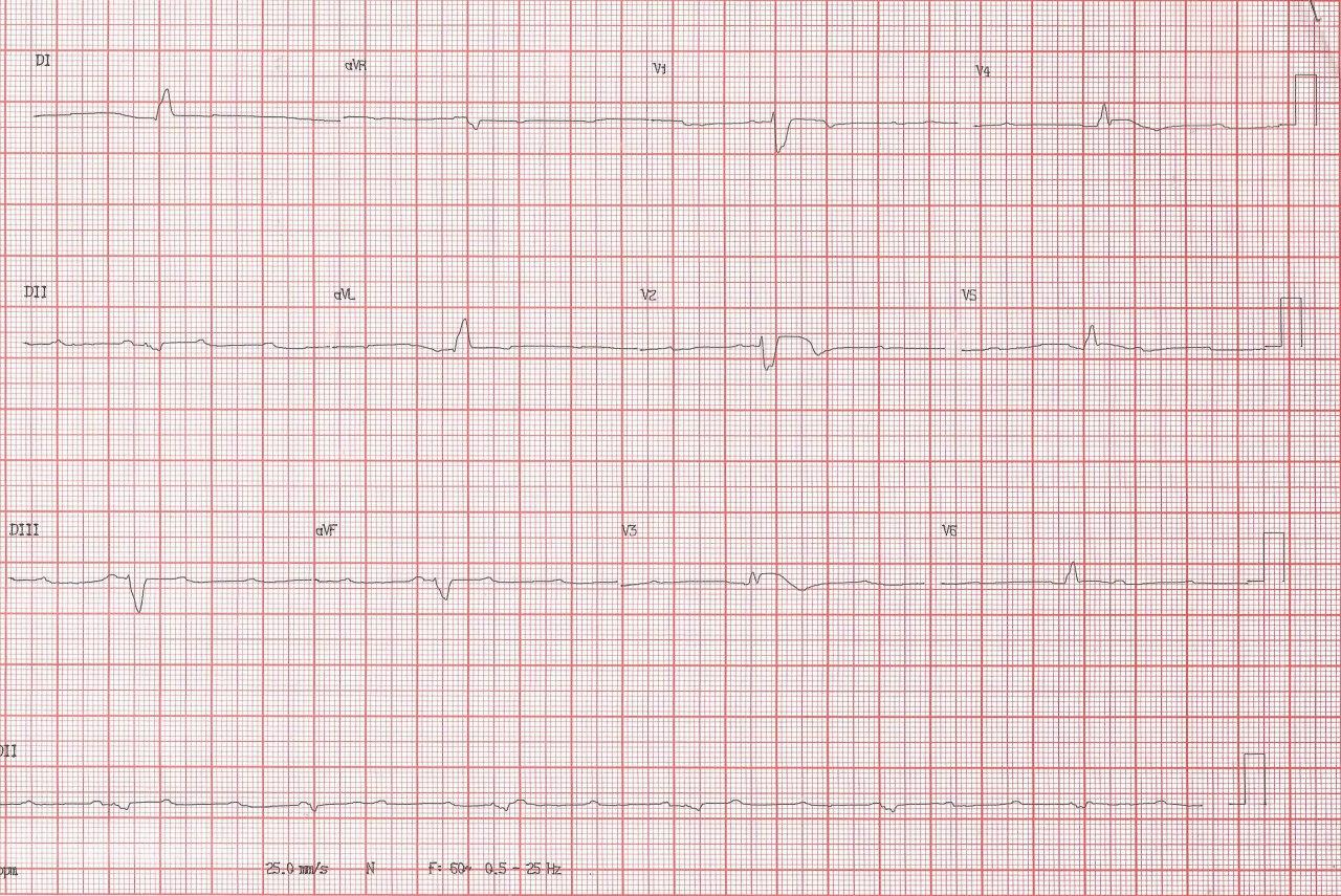 Hombre de 82 años con disnea súbita y síncope por BAV de alto grado originado en IAM anterior por oclusión de arteria DA