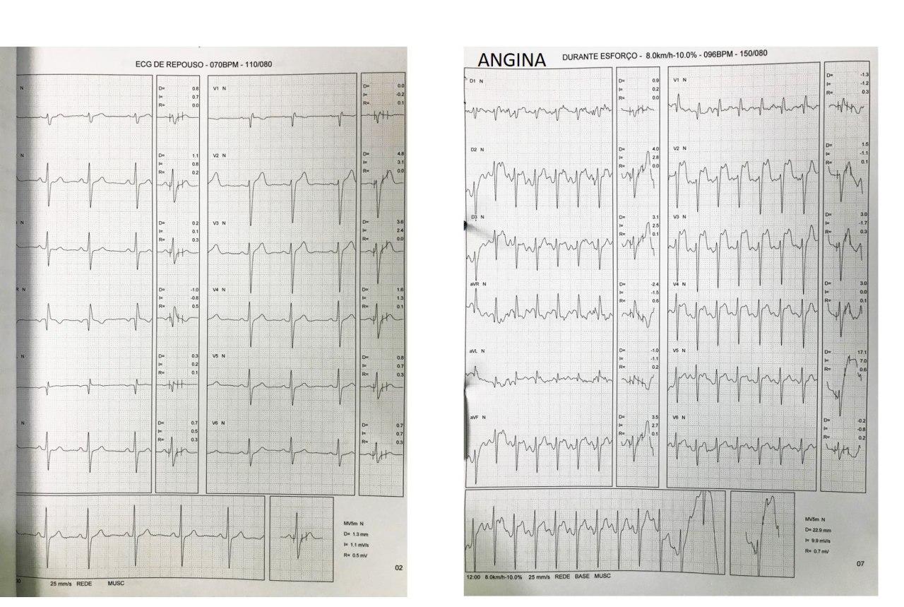 Paciente masculino de 24 años con opresión toráccica intraesfuerzo correpondiendo a una angina vasoespástica inducida por el ejercicio