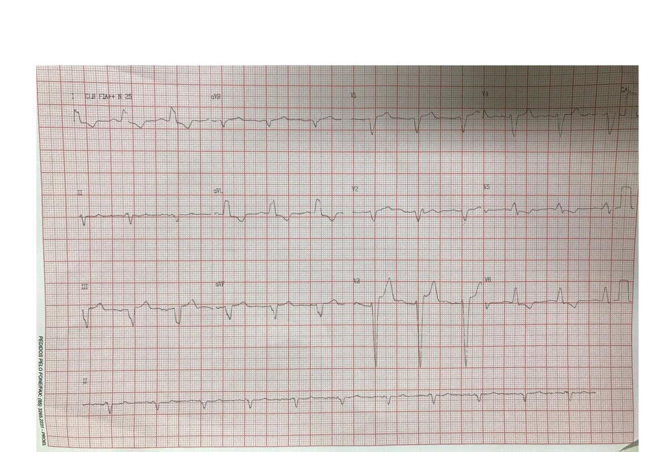 Mujer de 67 años ex fumadora que presenta disnea de esfuerzo debido a presencia de miocardiopatía dilatada de origen isquémico por enfermedad de dos vasos (DA y Cx)