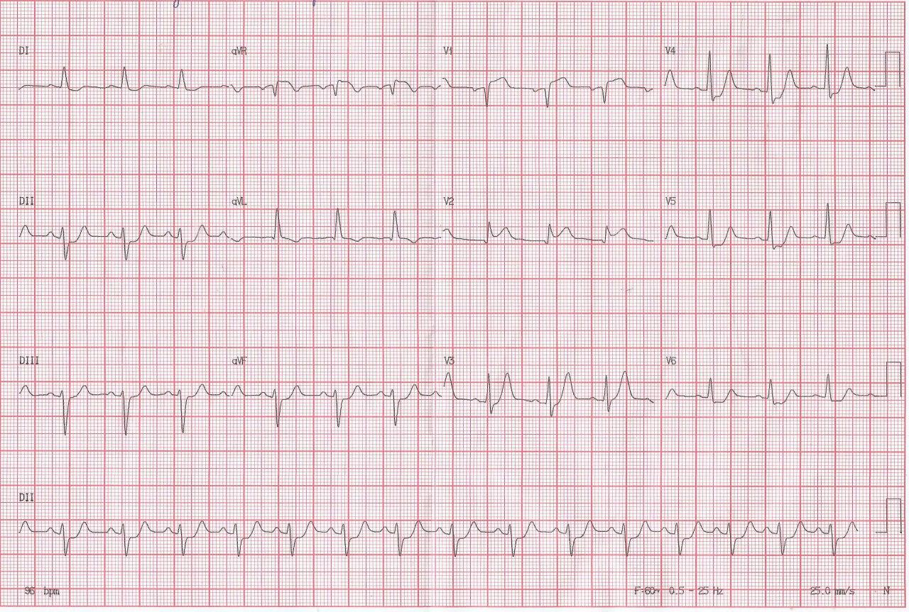 Hombre de 64 años con angor prolongado debido a isquemia subendocárdica regional, haciéndose el diagnóstico diferencial con isquemia circunsferencial