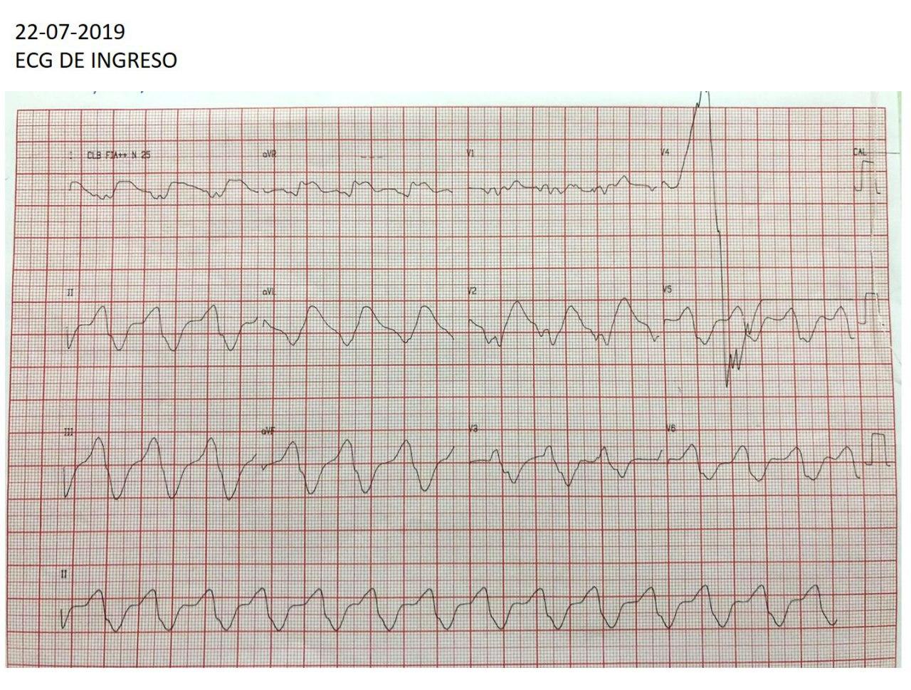Mujer de 83 años con vómitos, diarrea y oliguria que cursa con severa hiperpotasemia que mejora con la infusión de gluconato de Ca
