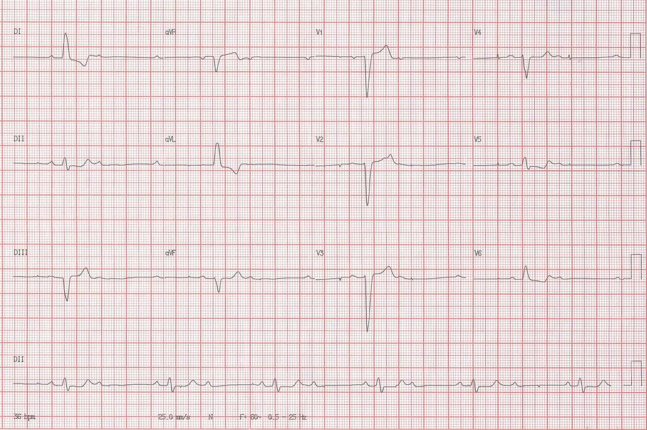 Mujer de 74 años con severa estenosis aórtica y Enfermedad de Lev que presenta episodio sincopal por falla de captura de MP transitorio