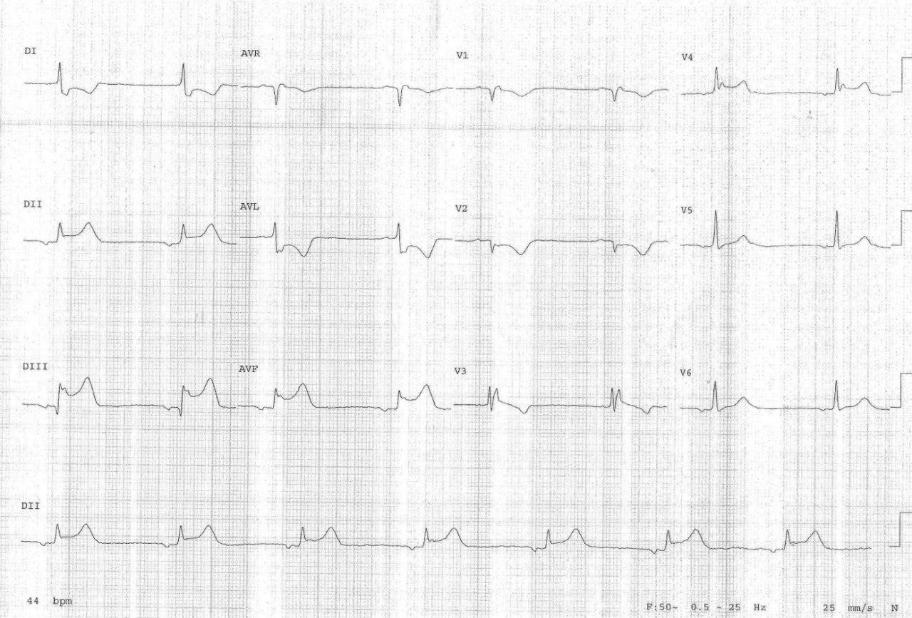 Paciente de 82 años con angor nocturno y síncope por disfunción sinusal por isquemia auricular debido a compromiso de CD proximal que es angioplastiada