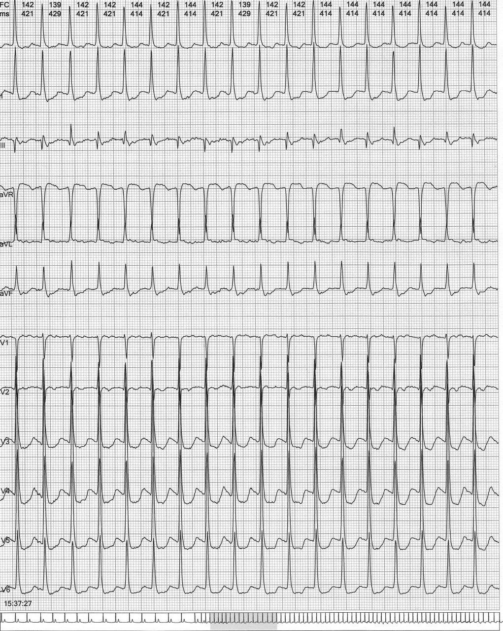 Paciente masculino de 71 años con palpitaciones debidas a TRAVO que es sugerida por la presencia de elevación del ST en derivación avR