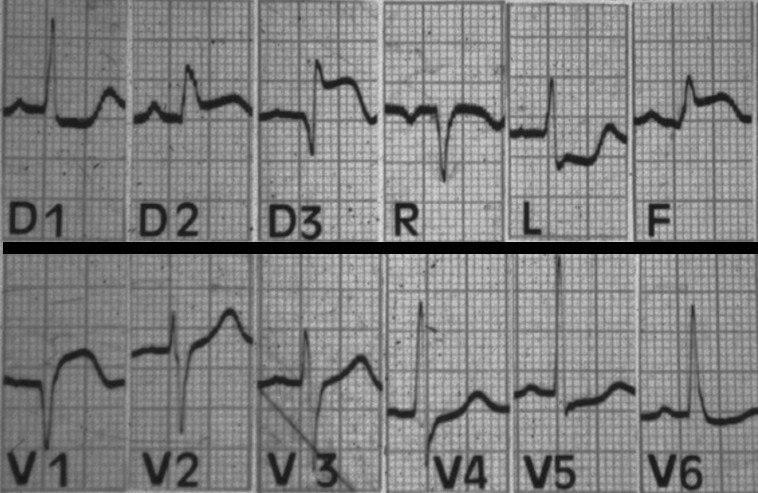 Paciente que cursa síndrome coronario agudo con IAM de VD por compromiso de la CD proximal