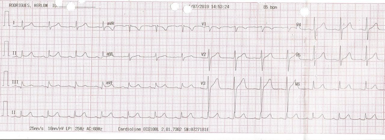 Hombre de 37 años, alcoholista y consumidor de cocaína y marihuana que presenta signos de repolarización precoz en cara inferior