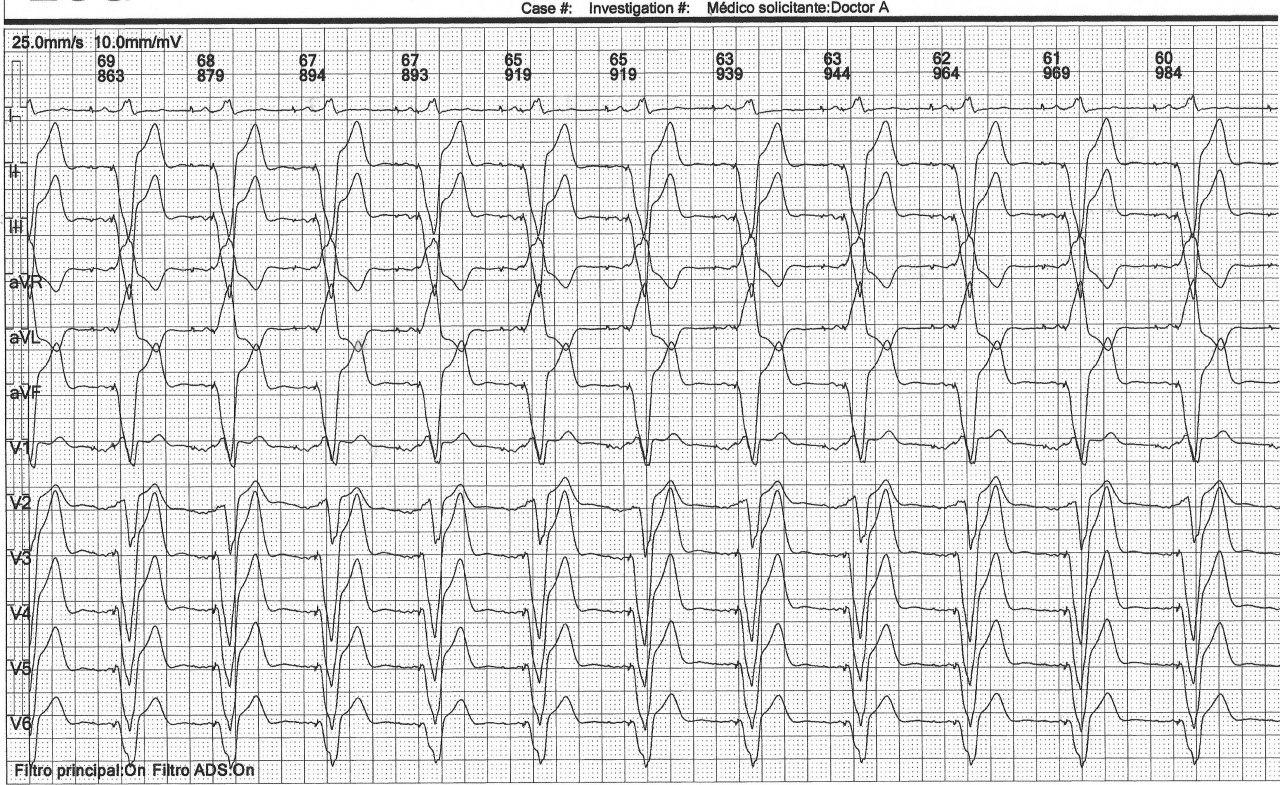 Hombre portador de MP bicameral con historia de FA paroxística que presenta una BIA-A atípico estimulado
