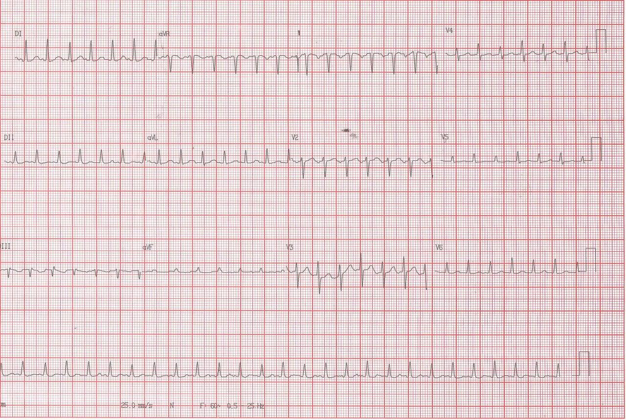 Gestante de 30 años con palpitaciones por presencia de taquicardia auricular ectópica con foco adyacente a nódulo sinusal por lo cuál la taquicardia simula ser una taquicardia sinusal inapropiada