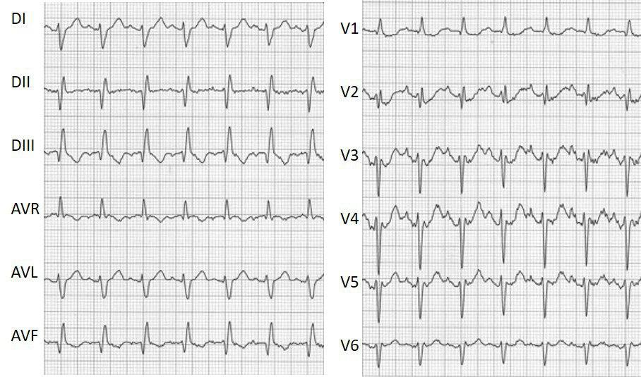 Mujer de 81 años con disnea y mareos con hiperpotasemia que presenta BAV de alto grado (falta ECG) que revierte al corregirse el medio interno, quedando con grados variables de BAV y trastornos de conducción