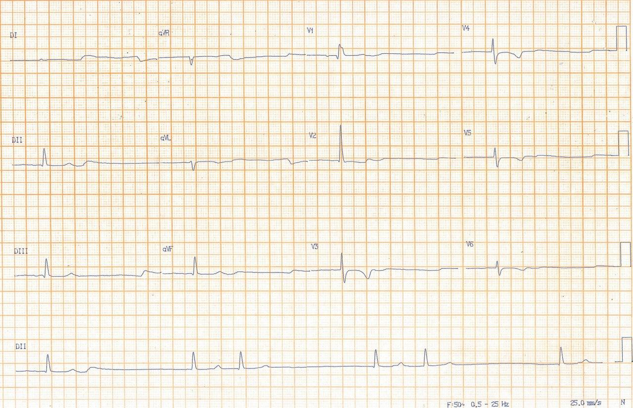 Hombre de 79 años en hemodiálisis por IRC que presenta presíncope y EAP con hallazgo de paro sinusal por hiperkalemia luego de faltar a dos sesiones y que mejora luego de reestablecer el tratamiento dialítico