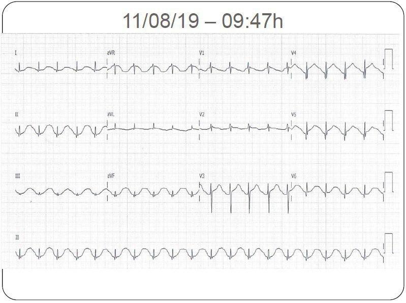 Mujer de 56 años es hallada inconciente con hematemesis luego de ingesta alcohólica que presenta hipokalemia con gran hematoma subdural y hemorragia parenquimatosa