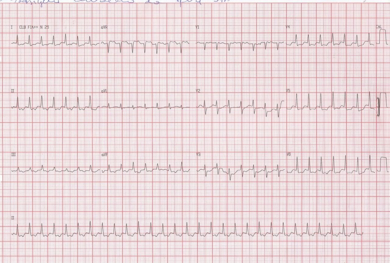 Mujer de 34 años con palpitaciones por TRIN lento-rápida