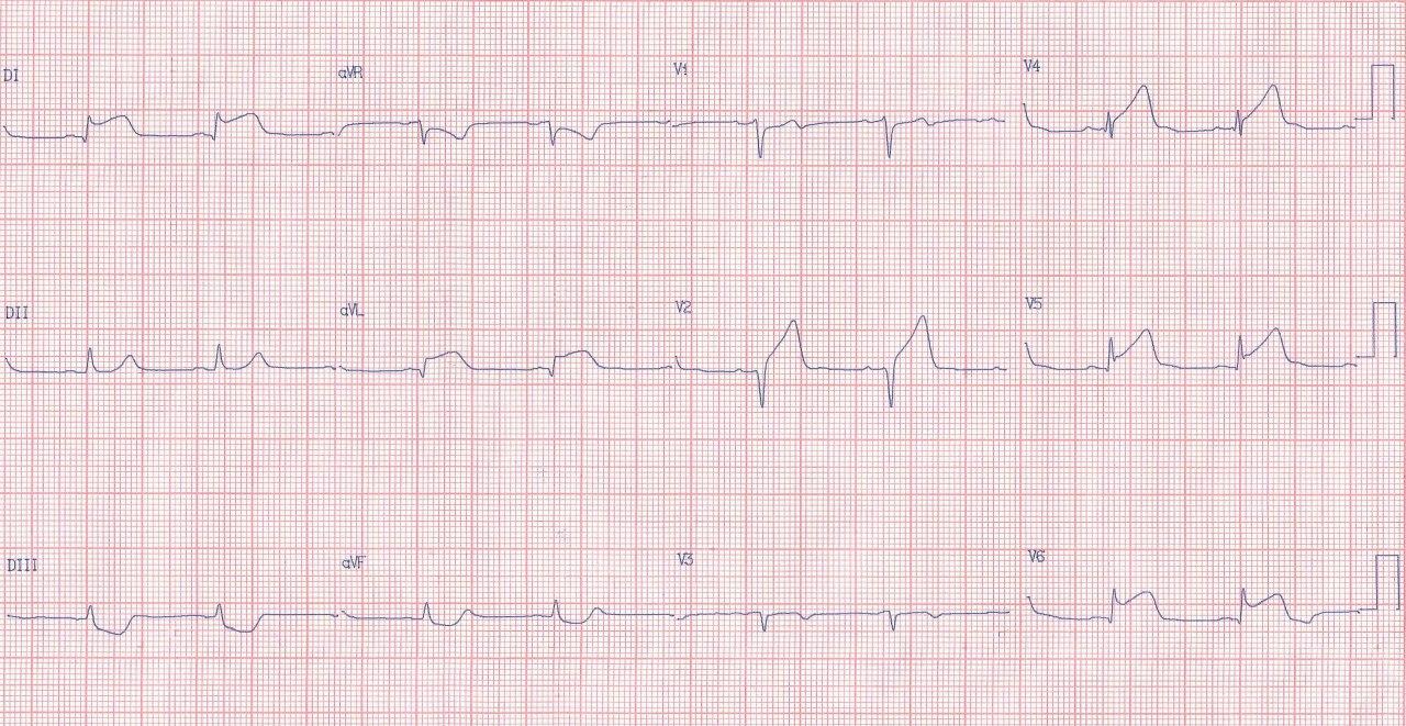 Paciente cursando IAMCEST de cara ánterolateral media/baja por compromiso de la arteria 1ª diagonal