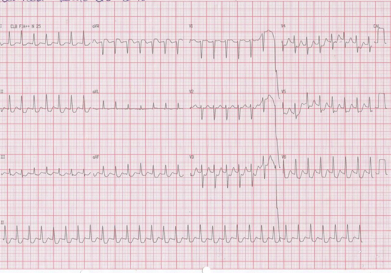 Mujer de 71 años con antecedentes de enfermedad coronaria e implantes de stents con angor y palpitaciones por presencia de TRIN, con típica «pseudo r» en V1 y «pseudo s» en derivaciones de los miembros