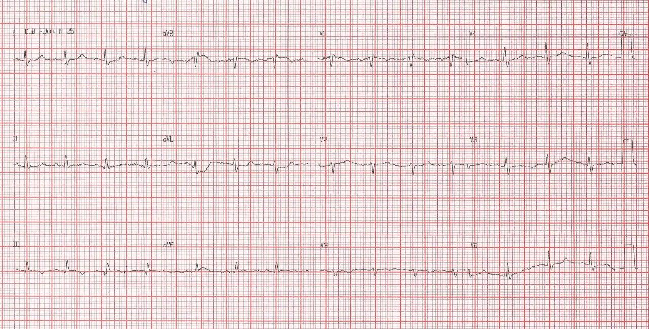 Paciente de 72 años que refiere disnea súbita y dolor precordial con hallazgo de signo de S1Q3T3 en el ECG y amputación de ambas arterias pulmonares en Rx por TEP bilateral e infarto pulmonar