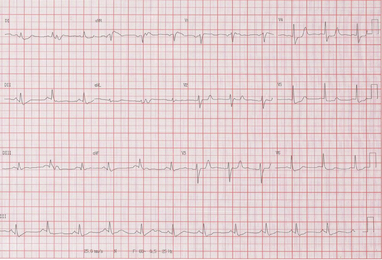 Mujer que presenta angor prolongado por compromiso de arteria Cx