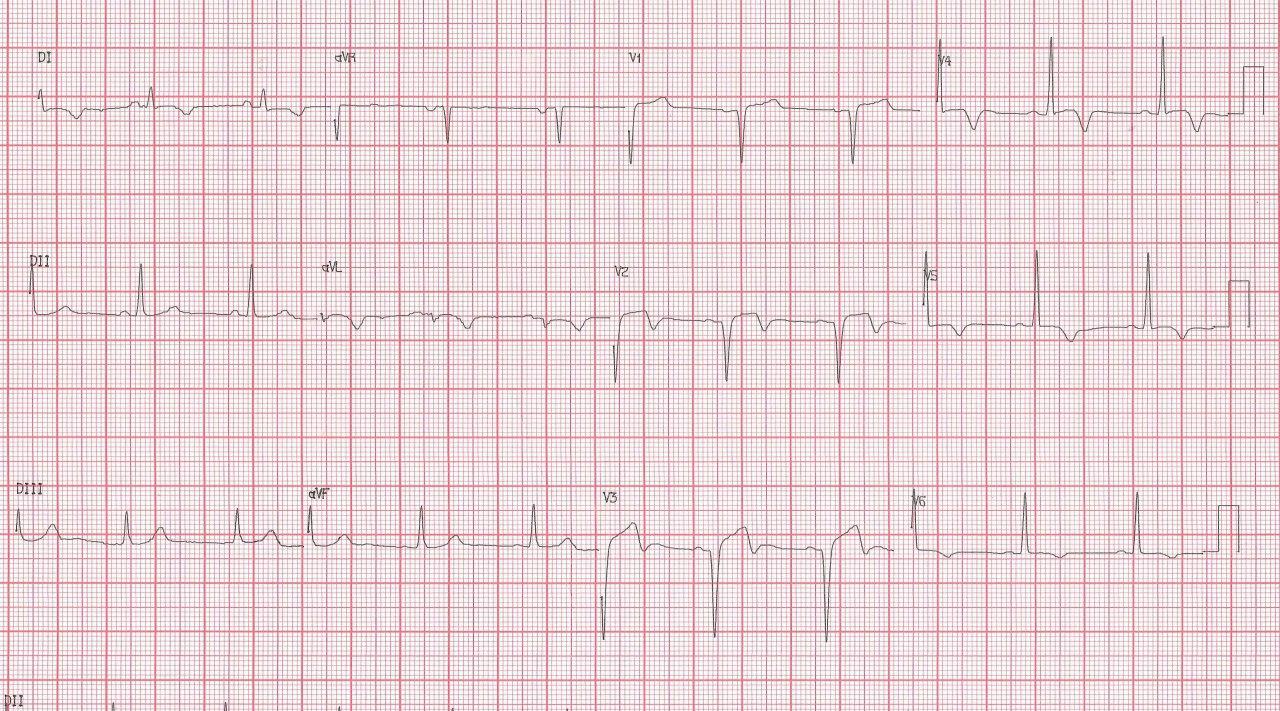 Hombre de 64 años con múltiples factores de riesgo que presenta angor prolongado de reposo por presentar suboclusión de la DA, con onda T bifásica en V2 V3 indicativa de reperfusión incompleta con peligro inminente de IAM