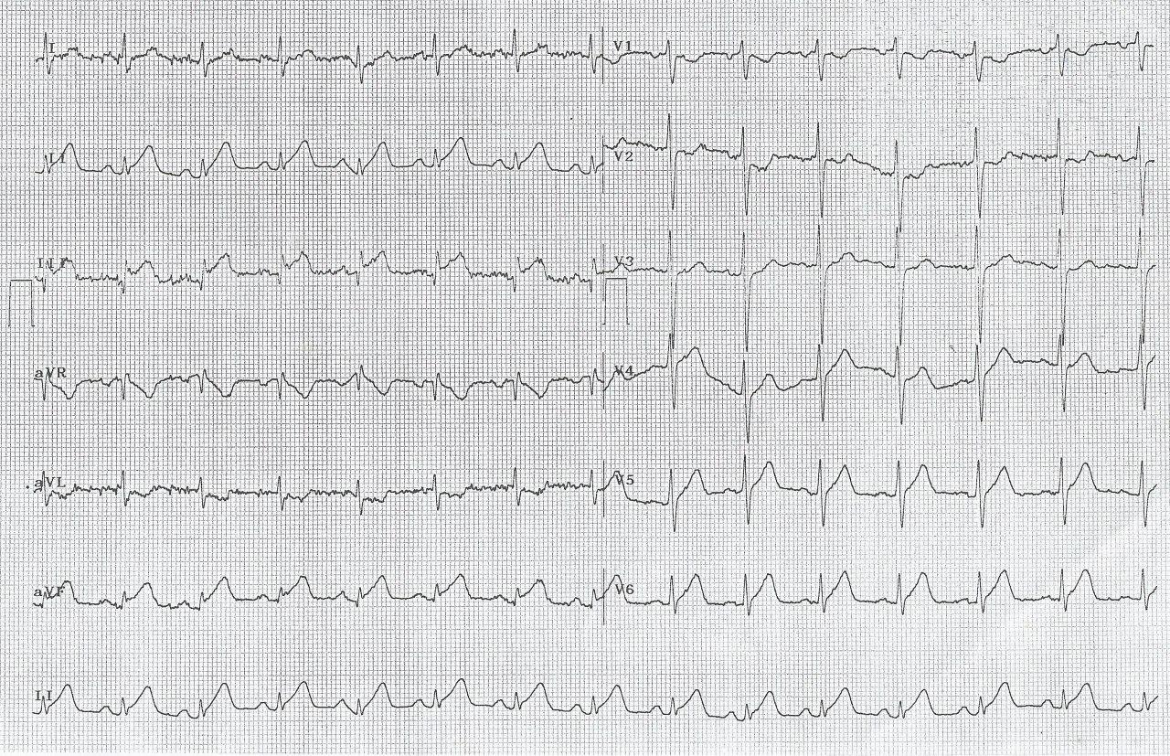 Paciente masculino de 32 años tabaquista crónico y consumidor de marihuana y cocaína que presenta angor prolongado por trombo en el TCI y oclusión distal de las arterias Cx y ramo diagonal