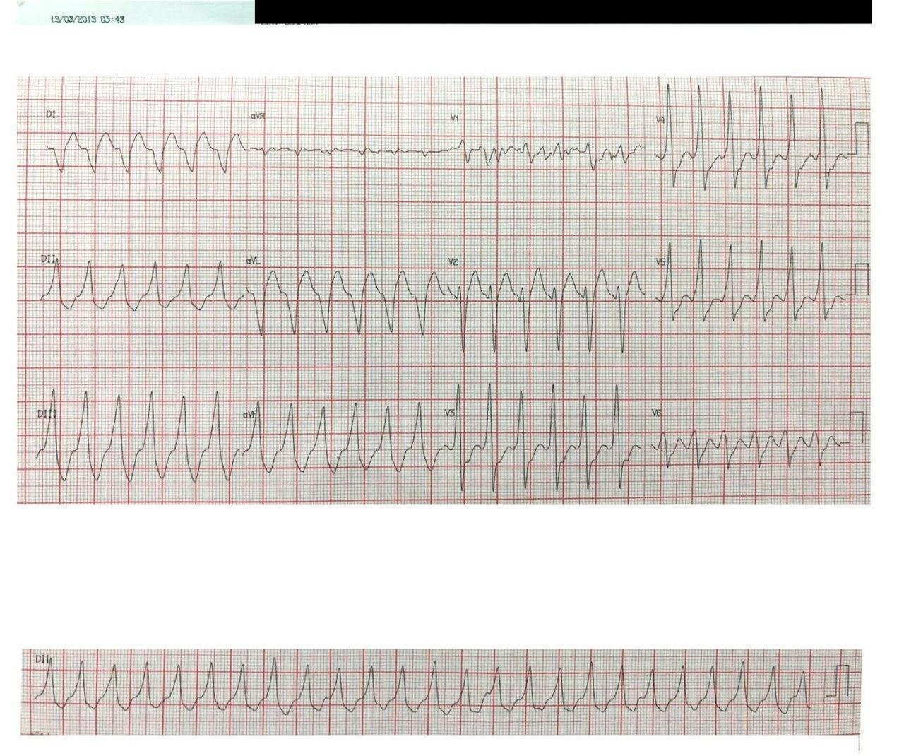 Paciente de 65 años con implante de CDI hace varios años que actualmente se halla agotado y que presenta mareos y episodios sincopales por desarrollo de TV
