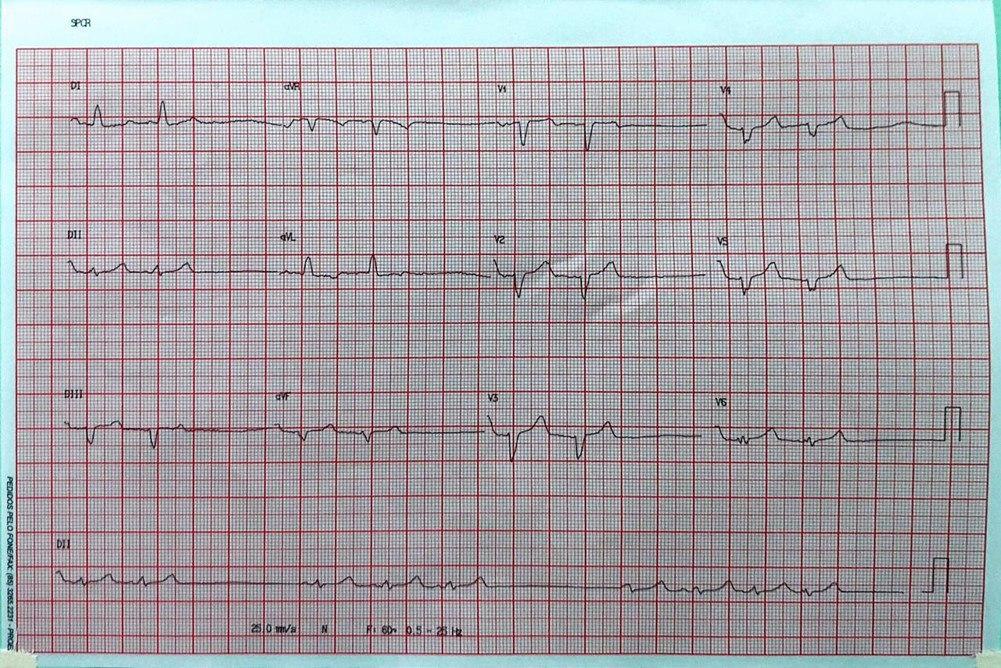 Hombre de 58 años con múltiples factores de riesgo y disnea progresiva que presenta disfunción del nódulo sinusal por hiperkalemia