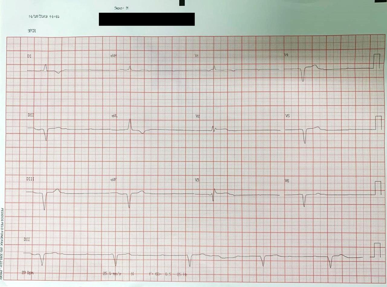 Hombre de 81 años con cuadro de IRC que presenta BAVC por intoxicación digitálica