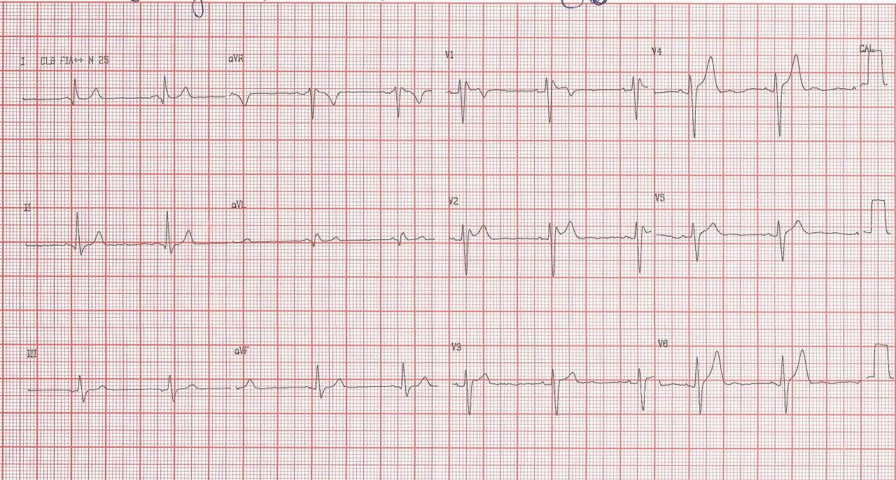 Paciente masculino de 36 años con palpitaciones y síncope que tiene antecedentes de MS familiar que presenta patrón ECG de Brugada + WPW intermitente