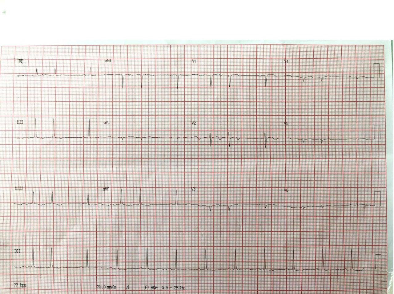 Mujer de 77 años, hipertensa y diabética que manifiesta disnea paroxística nocturna como único síntoma y que presenta una suboclusión en la DA