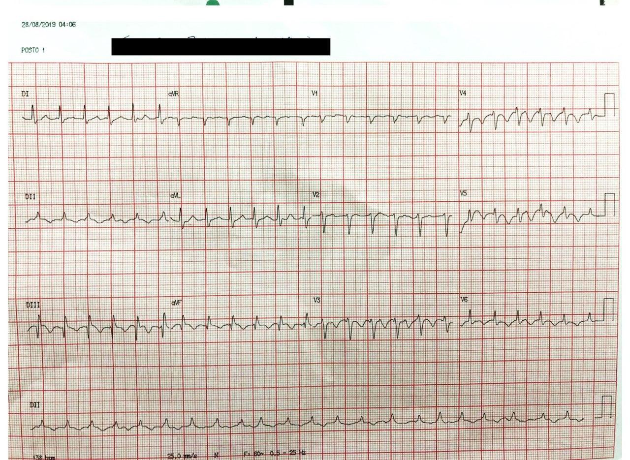 Hombre de 88 años con antecedente de trombosis venosa profunda que presenta disnea súbita y síncope por desarrollo de TEP observándose patrón típico de S1Q3T3 y aleteo auricular