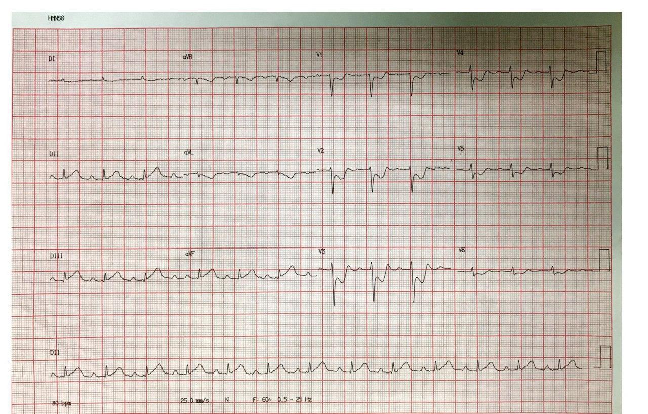 Mujer de 77 años con angor prolongado que presenta SCACEST por lesión de TCI y enfermedad de tres vasos con arteria Cx que se origina en CD