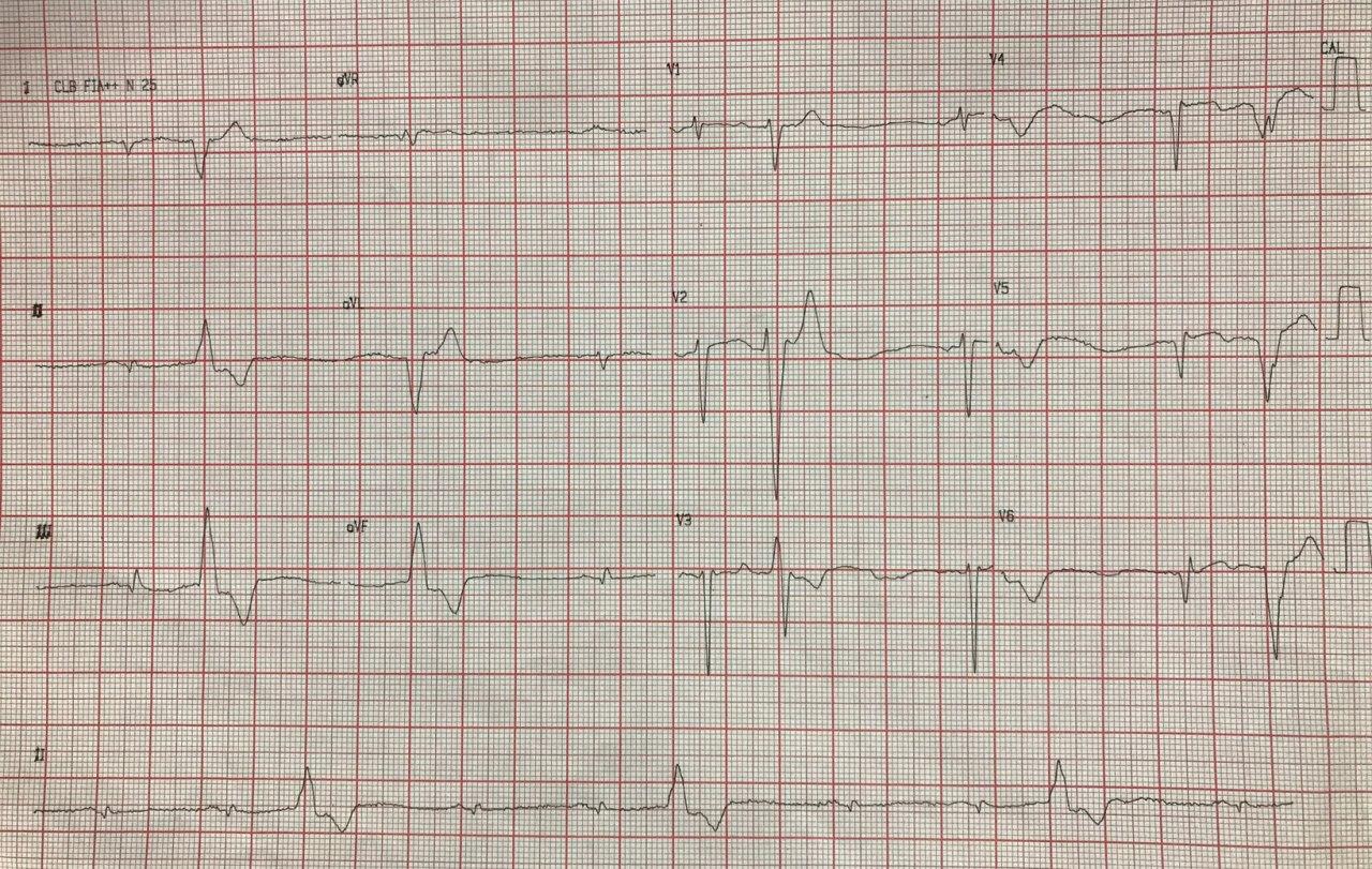 Paciente masculino de 65 años, alcoholista, con historia de angor, disnea y edemas de MMII,  que presenta palpitaciones por presencia de miocardiopatía dilatada y lesión de Cx