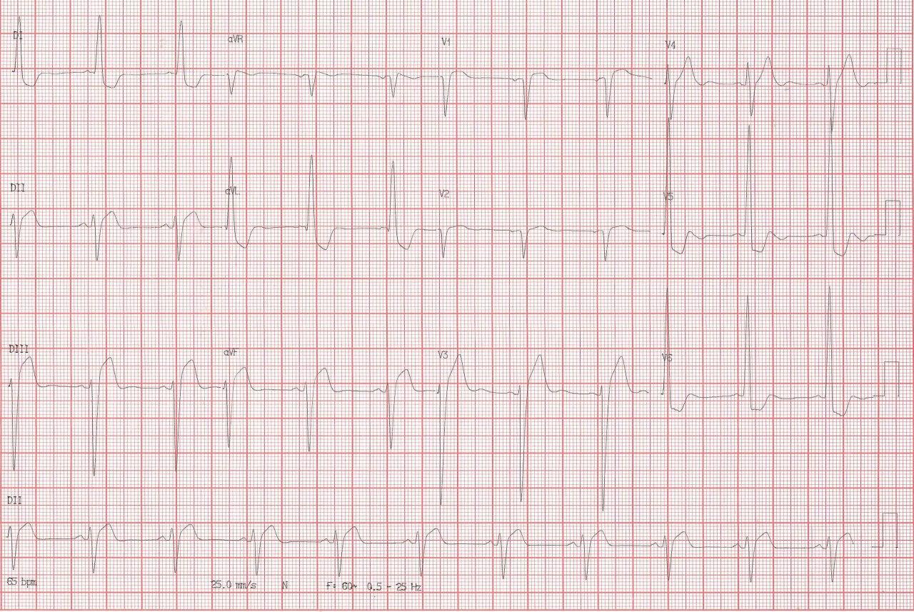 Paciente tratado crónicamente con digoxina que ingresa con EAP, náuseas y vómitos, que presenta esclerosis aórtica e HVI con signos electrocardiográficos de intoxicación digitálica