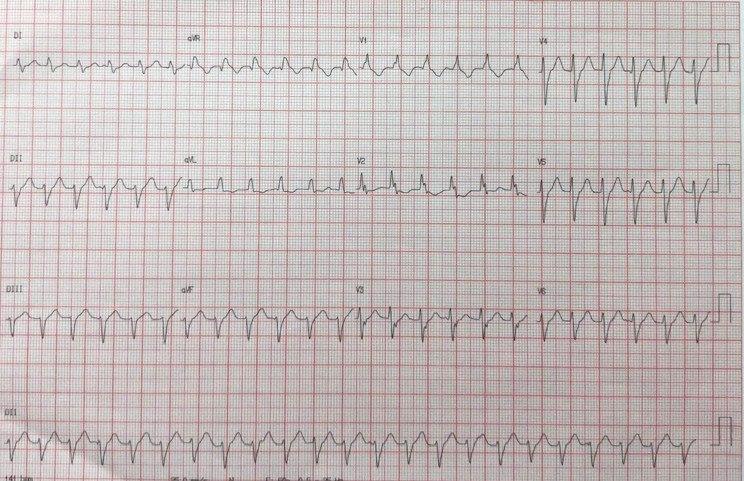Paciente masculino de 57 años con antecedente de cirugía de revascularización un año antes que presenta hipoquinesoa ánteroseptal con queja de palpitaciones por presencia de taquicardia ventricular fascicular