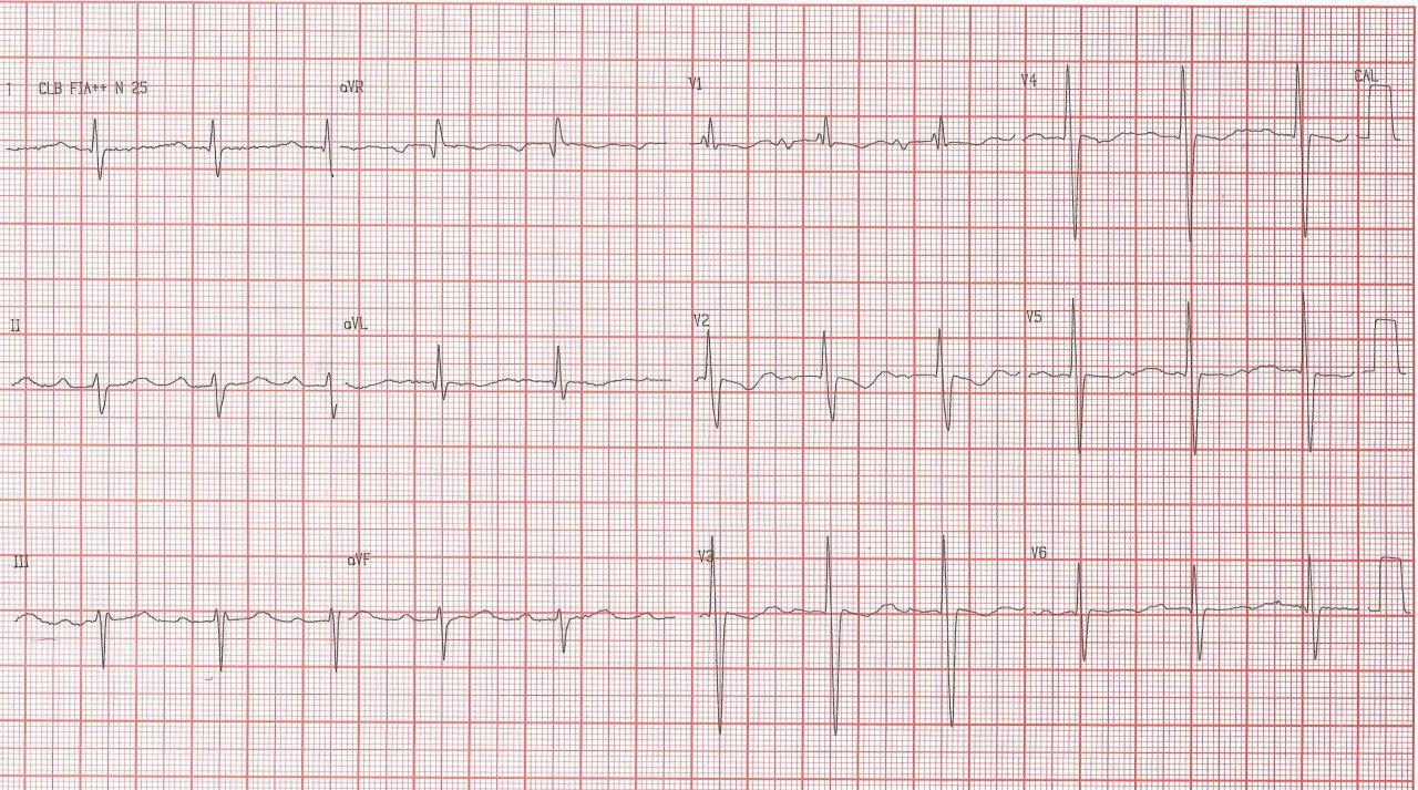Paciente masculino de 66 años con palpitaciones y disnea por presencia de CIA ostium prímun descubierta a los 26 años