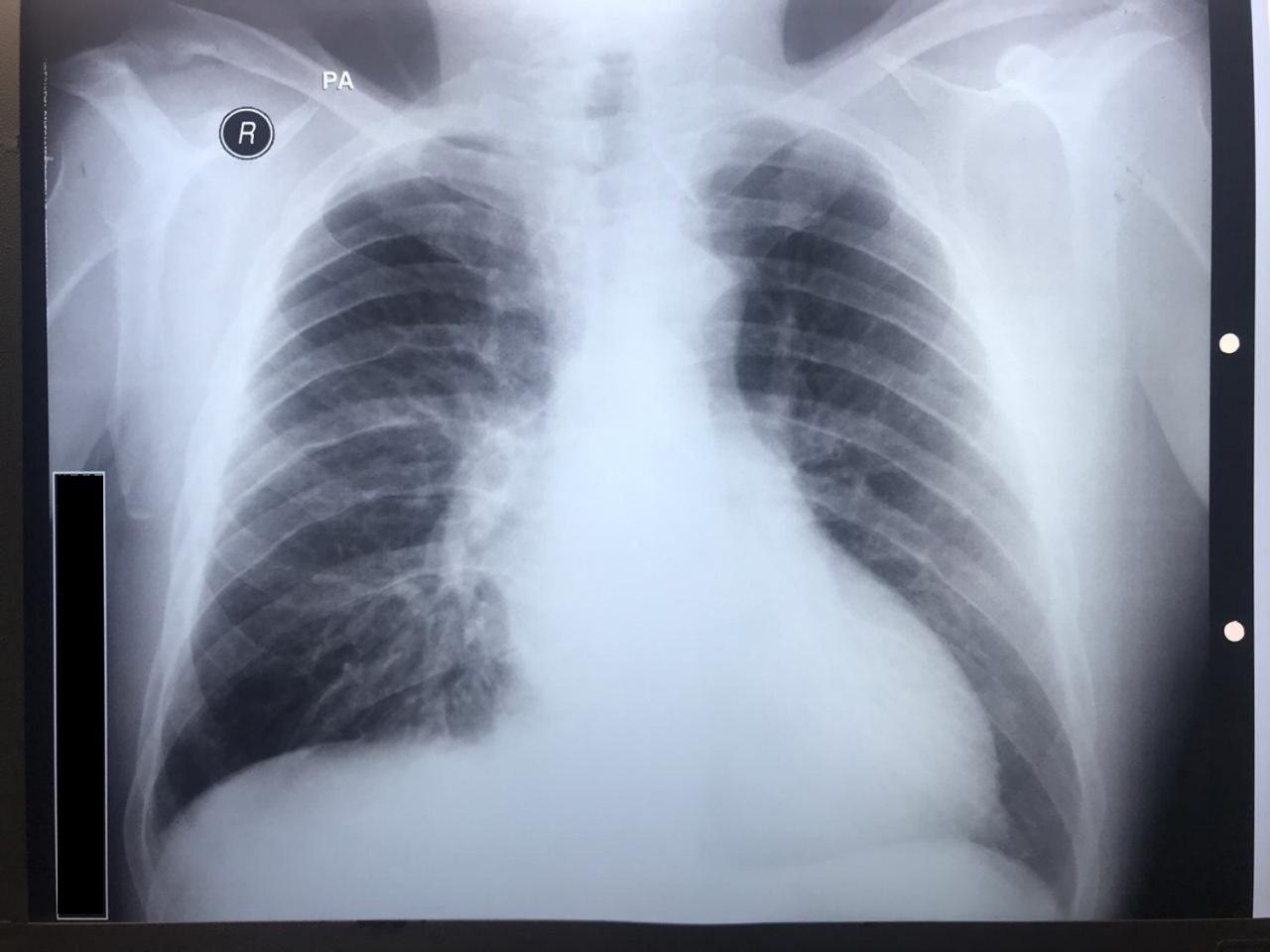 Paciente masculino de 48 años con hipertensión arterial sistólica mal controlada con soplo sistólico intenso en FAo que presenta signo de Roesler en costillas por presencia de coartación aórtica