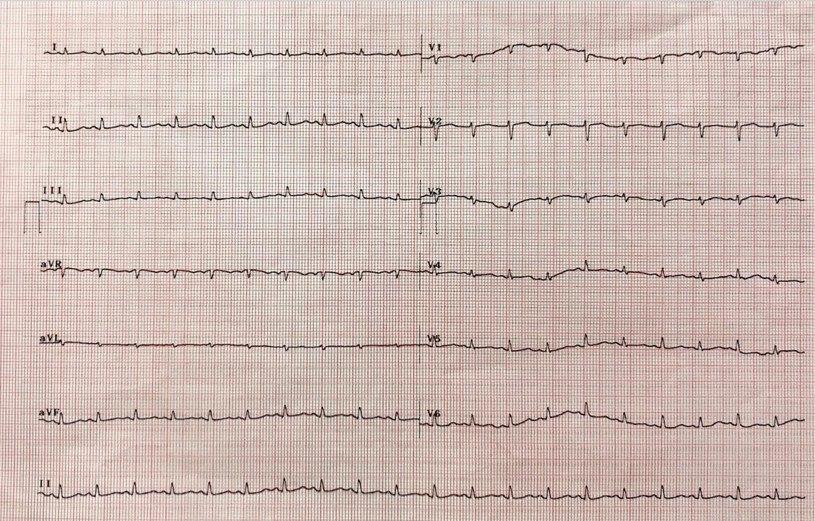 Mujer de 61 años con disnea progresiva por severo derrame pericárdico metastásico