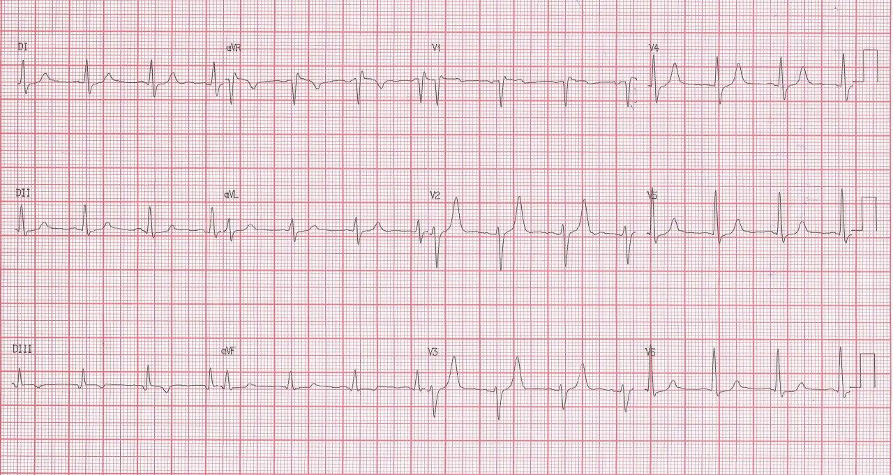 Hombre de 68 años en IRC dialítica con hiperpotasemia, que presenta epidodio de angor por compromiso de la DA