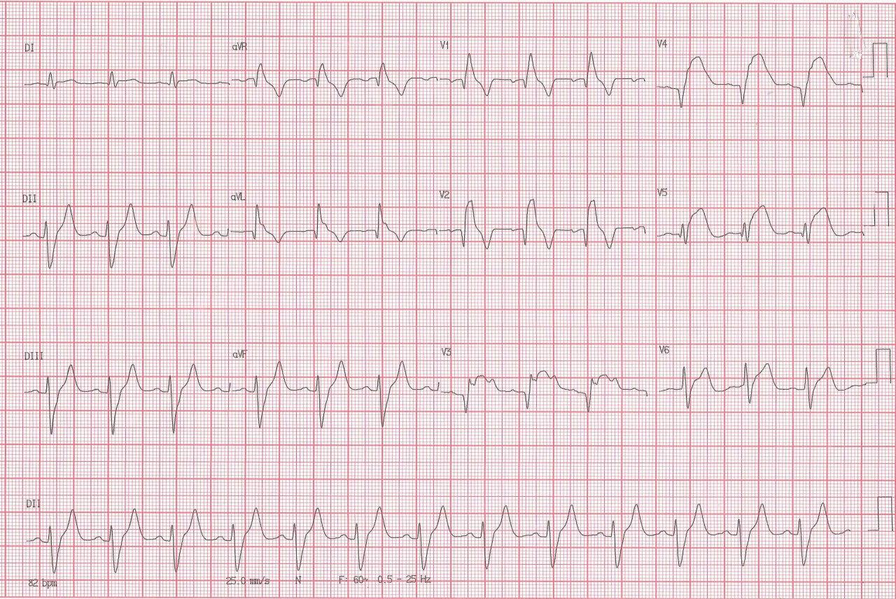 Hombre de 56 años con episodio de angor prolongado por SCA debido a compromiso de DA antes de la 1ª septal