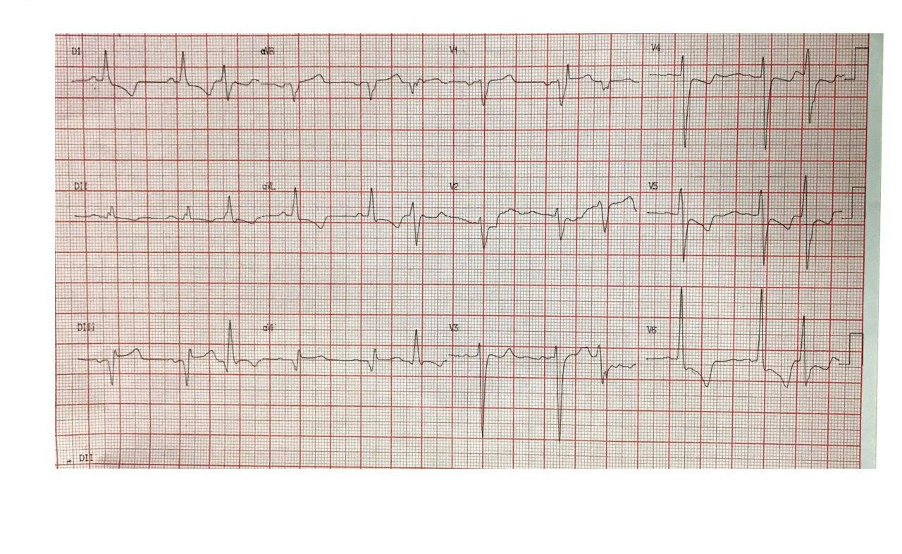 Paciente de 56 años portador de estenosis aórtica con angor y disnea progresivos que presenta disección en arteria CD