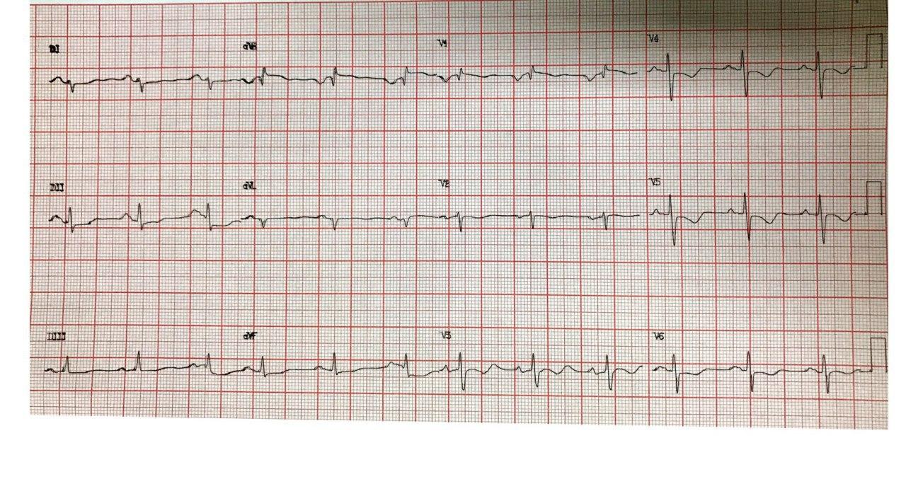 Mujer de 51 años portadora de estenosis mitral reumática con disnea y precordialgia que presenta hipertensión pulmonar severa