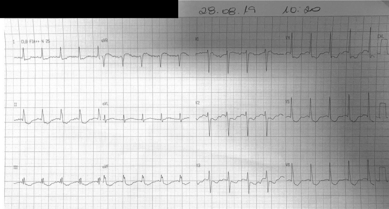 Mujer hipertensa, diabética y dislipémica que presenta dolor precordial en quién se constata arterias coronarias angiográficamente normales y severa kipopotasemia