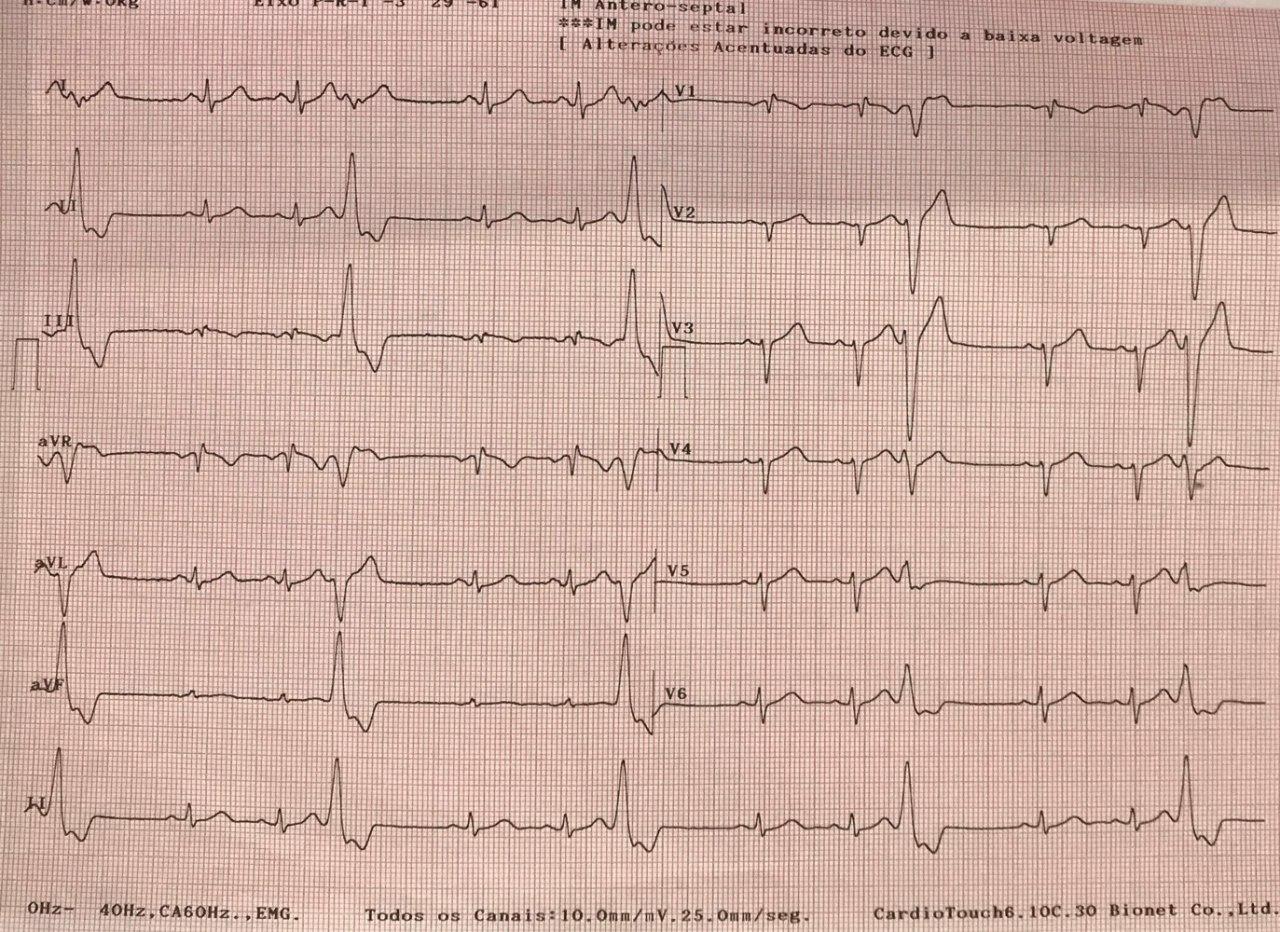 Mujer de 56 años con múltiples factores de riesgo que manifiesta angor con presencia de episodios cortos de TVNS debidos a la presencia de puente muscular en tercio medio de DA