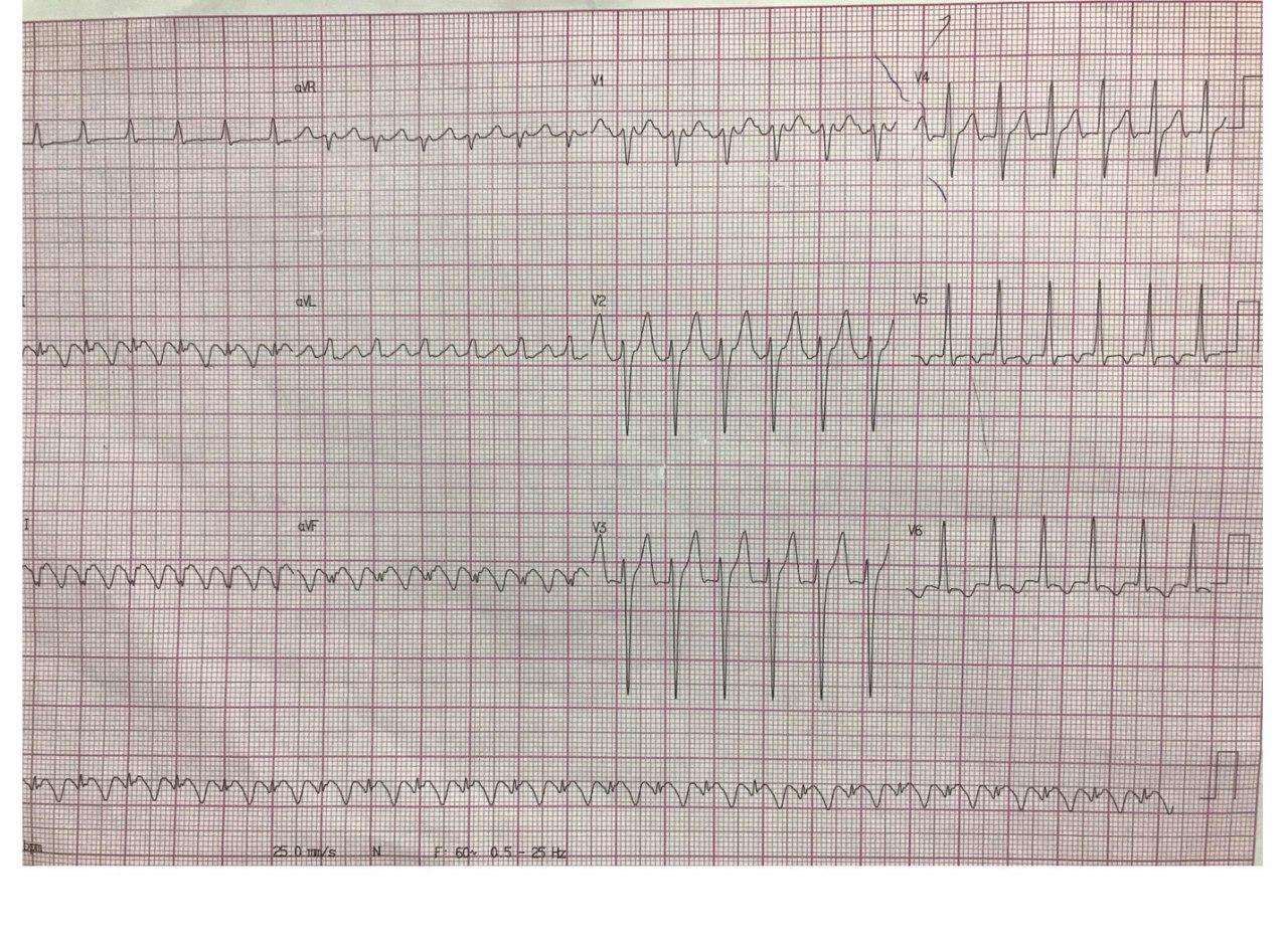 Hombre de 51 años que presenta angor, palpitaciones y disnea constatándose AA 2:1 que se controla con amiodarona y que presenta lesión en arteria Cx