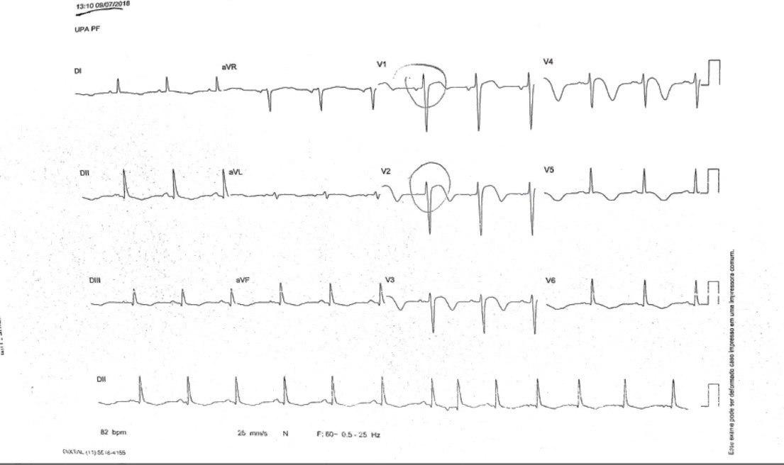 Paciente hipertenso y diabético con antecedente de ACV que presenta epigastralgia, náuseas y vómitos con CCG normal por síndrome de Tako Tsubo