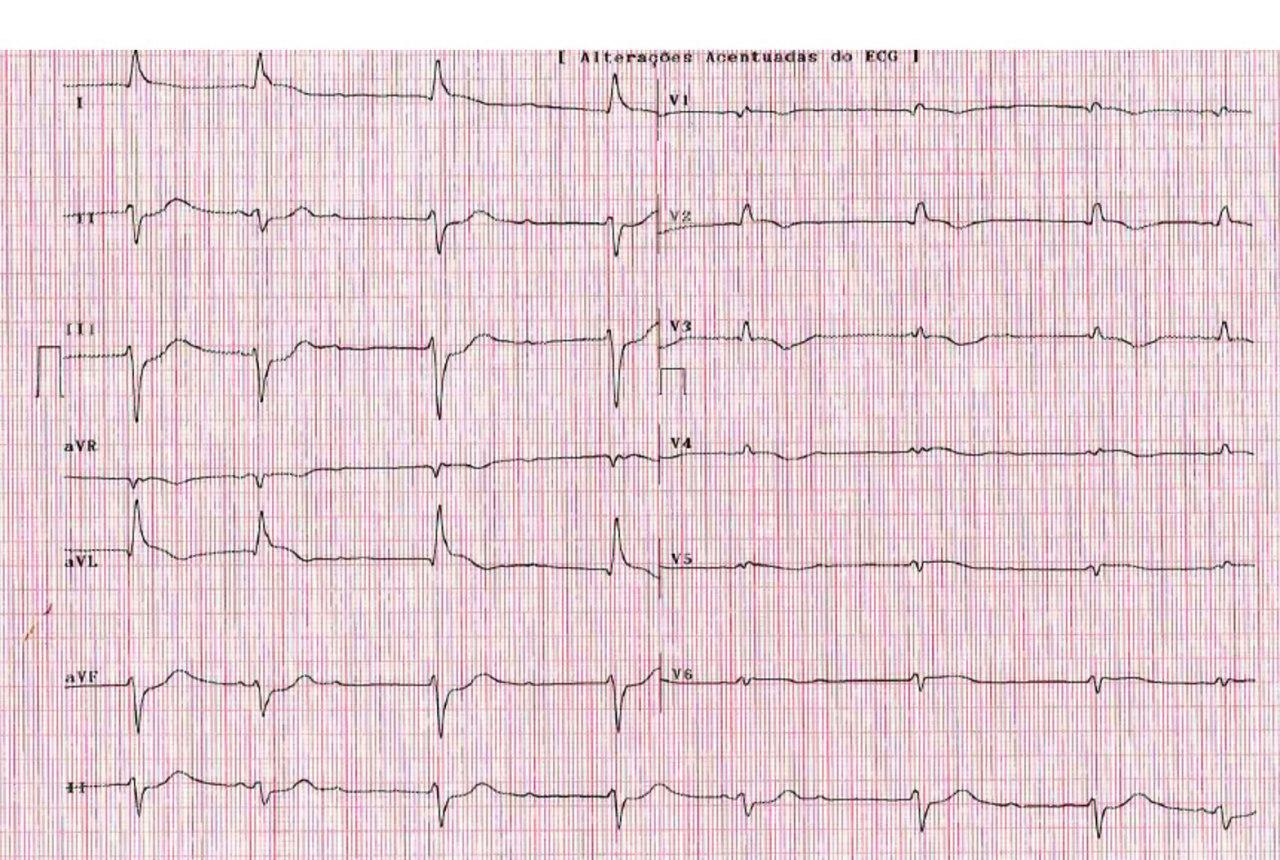 Mujer de 72 años con angor prolongado y severa disnea, náuseas y vómitos por compromiso de DA proximal y mala evolución