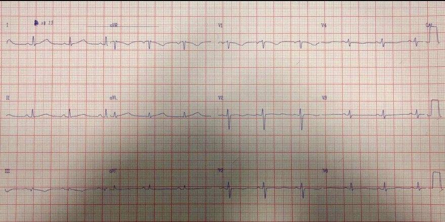 Mujer de 38 años que comienza con convulsiones y relajación esfinteriana en la que se constata FV originada en ser portadora de SQTL