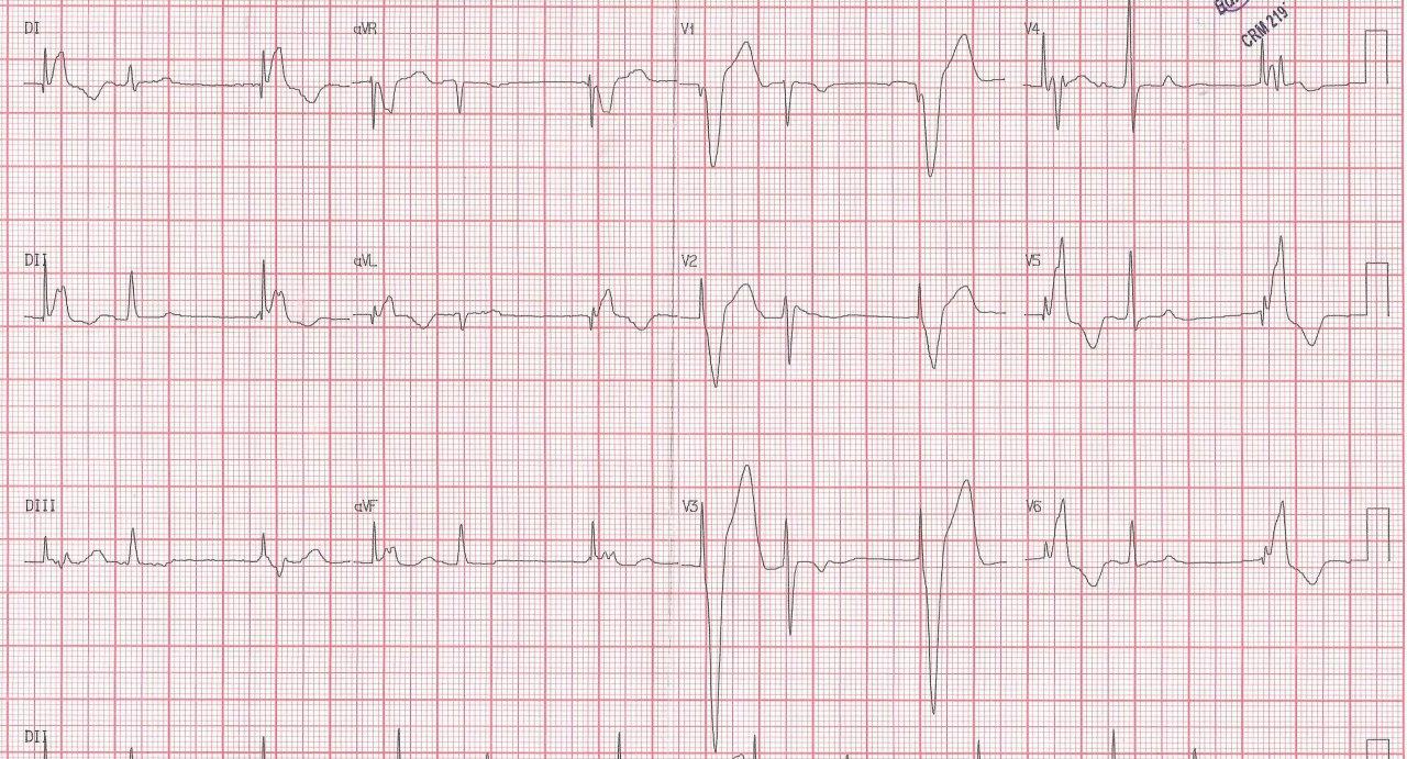 Hombre de 81 años portador de MP con supuesto antecedente de imfarto que en realidad corresponde a un síndrome de Brugada