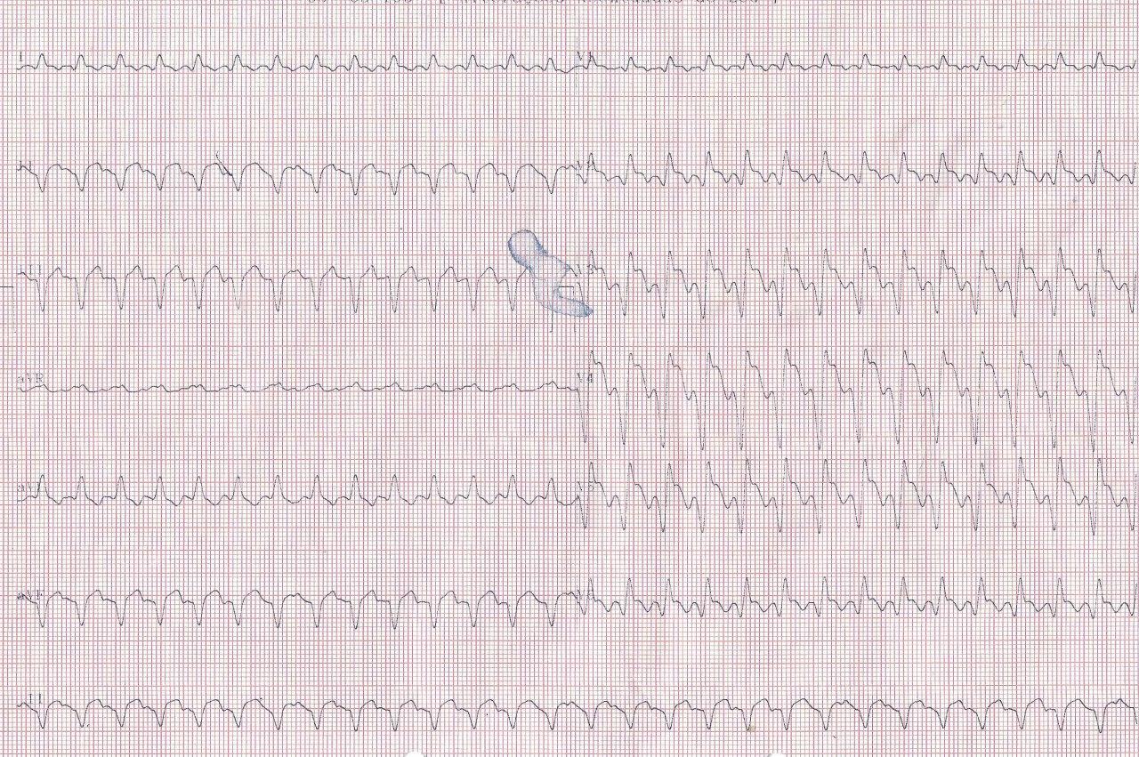 Paciente de 67 años que presenta TV, 4 días despues de implante de stent por SCACEST