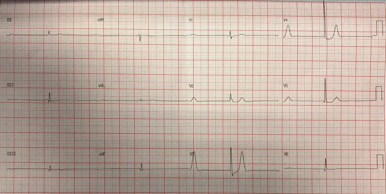 Paciente de 65 años con angor prolongado que presenta patrón de Winter electrocardiográfico en este caso por compromiso de arteria Cx