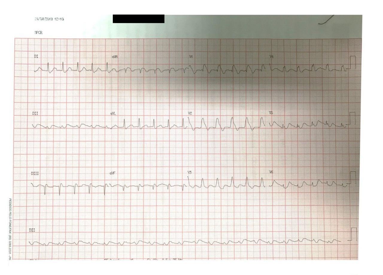 Paciente masculino de 80 años que presenta dolor precordial inspiratorio por compromiso de la DA proximal que es angioplastiada e imagen de patrón Brugada que se interpreta como fenocopia